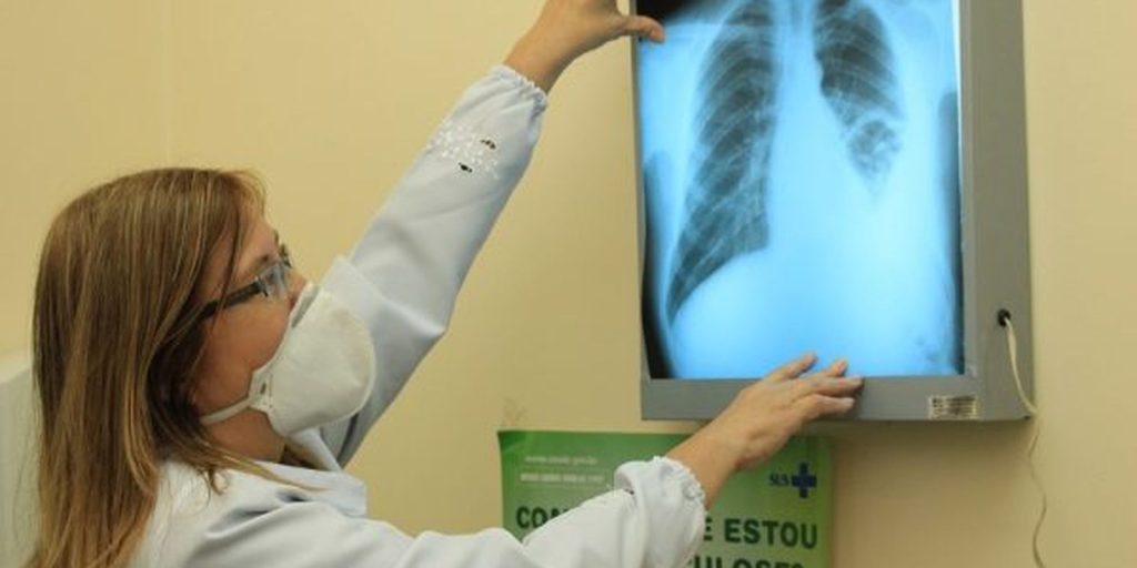 baixo-financiamento-mundial-ameaca-combate-a-tuberculose